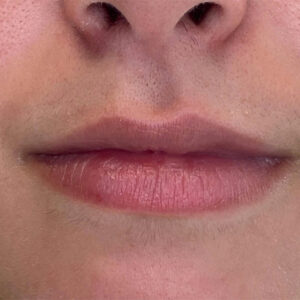 Lip Filler Before and After Photo by Coachlight Clinic & Spa in West Des Moines Iowa