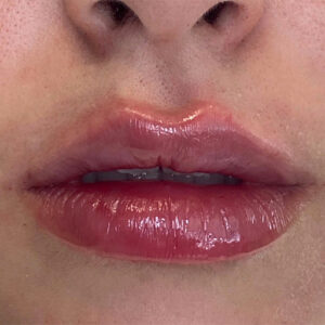 Lip Filler Before and After Photo by Coachlight Clinic & Spa in West Des Moines Iowa