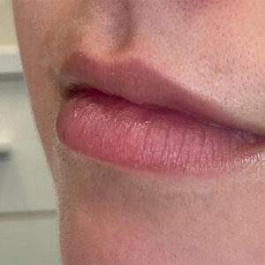 Lip Filler Before and After Photo by Coachlight Clinic & Spa in West Des Moines Iowa