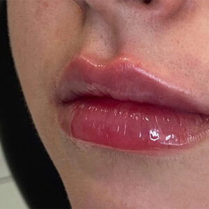 Lip Filler Before and After Photo by Coachlight Clinic & Spa in West Des Moines Iowa