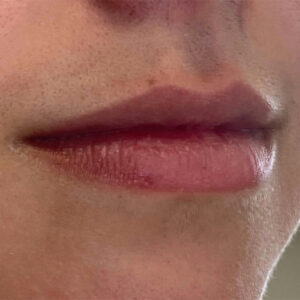 Lip Filler Before and After Photo by Coachlight Clinic & Spa in West Des Moines Iowa