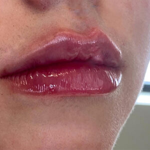 Lip Filler Before and After Photo by Coachlight Clinic & Spa in West Des Moines Iowa