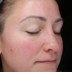 right oblique view before halo treatment