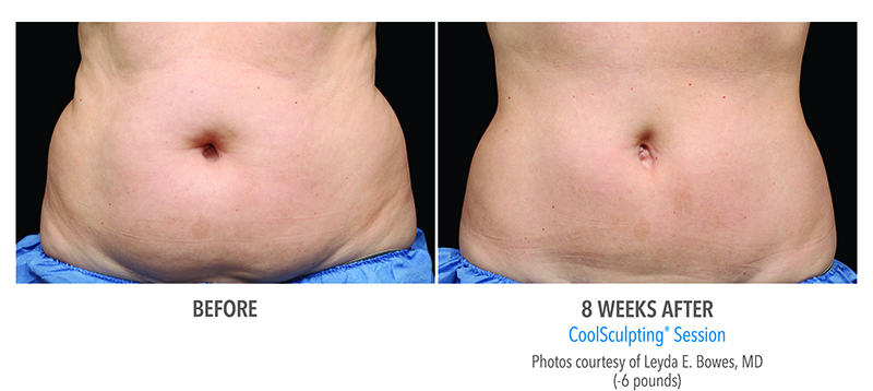 CoolSculpting in Abdomen before and after photo in Des Moines and Ankeny, Iowa