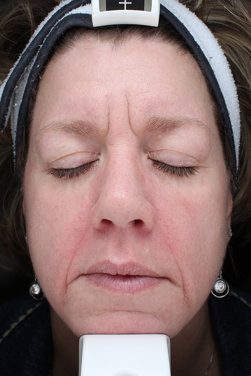 Summer Glow With Halo Pro 3 Summer Glow With Halo Pro After Photo By Coachlight Clinic &Amp; Spa In Des Moines And Ankeny, Iowa