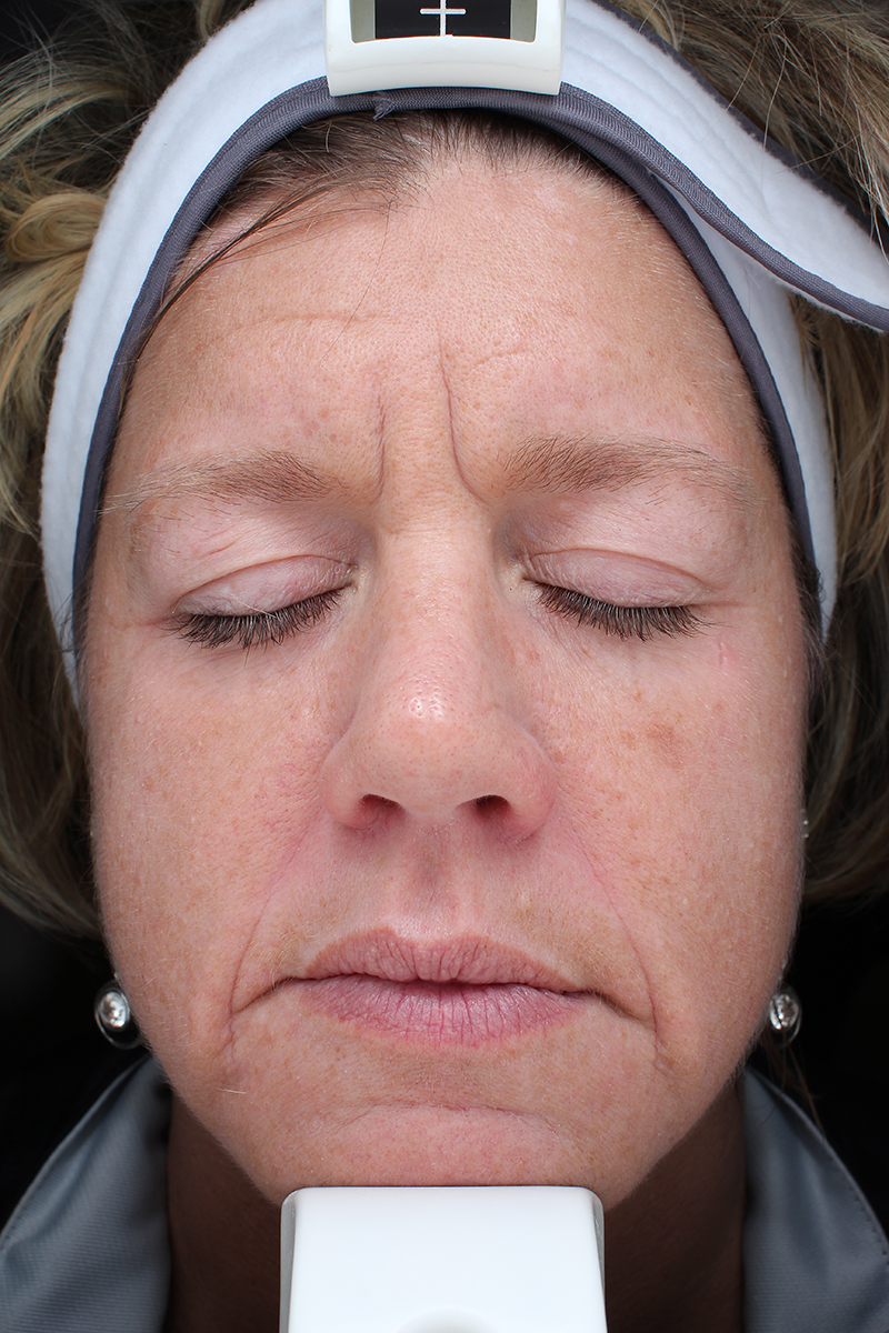 Summer Glow With Halo Pro before photo by Coachlight Clinic & Spa in Des Moines and Ankeny, Iowa