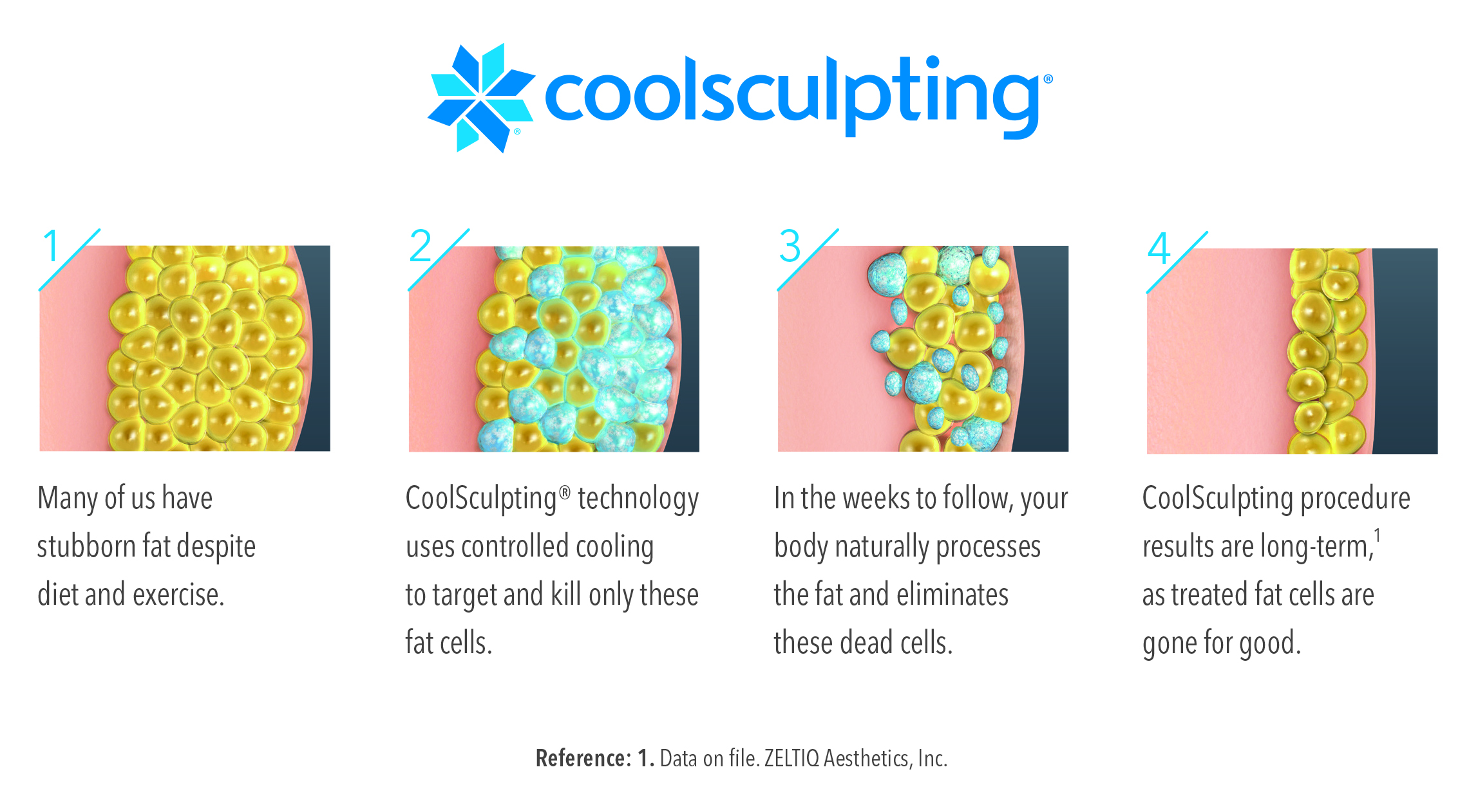 Coolsculpting Illustration