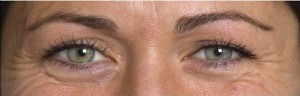 Crows feet