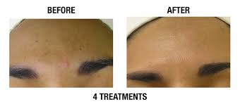 Water, Water Everywhere! 2 Hydrafacial Before And After Photo By Coachlight Clinic &Amp; Spa In Des Moines And Ankeny, Iowa