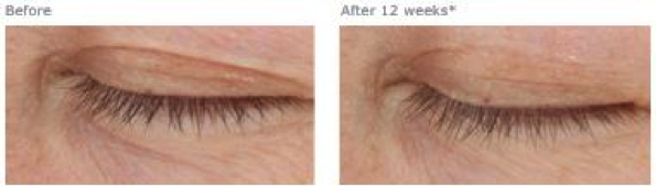 D·E·J Eye Cream™ before and after photo in Des Moines and Ankeny, Iowa