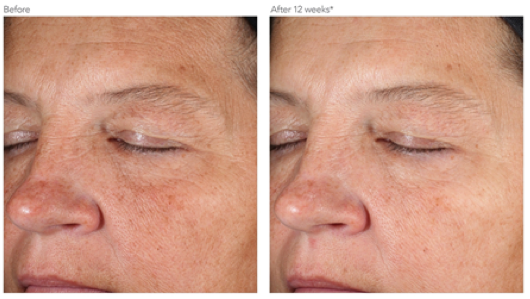 D·E·J Face Cream™ before and after photo in Des Moines and Ankeny, Iowa