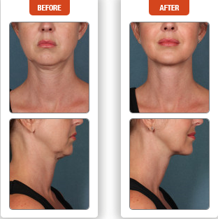 Kybella before and after photo in Des Moines and Ankeny, Iowa