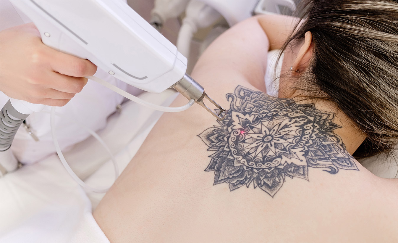 Top view hand of a beautician holds a laser device over a tattoo