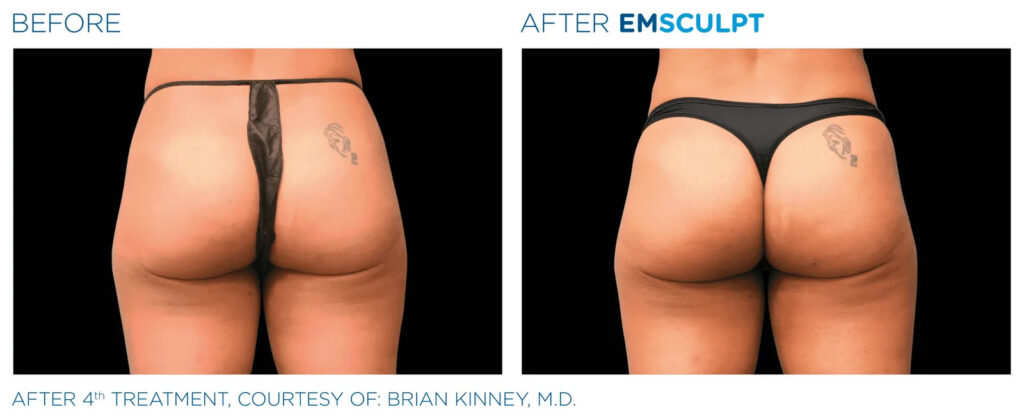 EMSCULPT buttocks female before and after