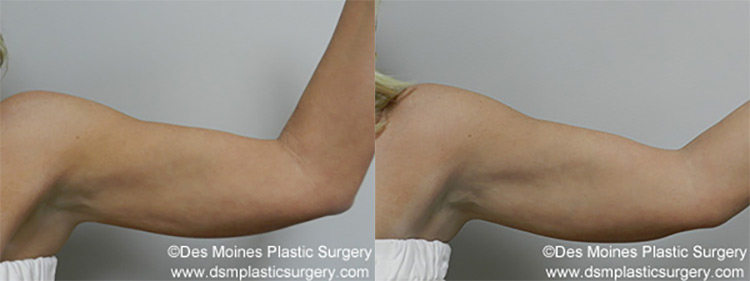 Exilis before and after photo