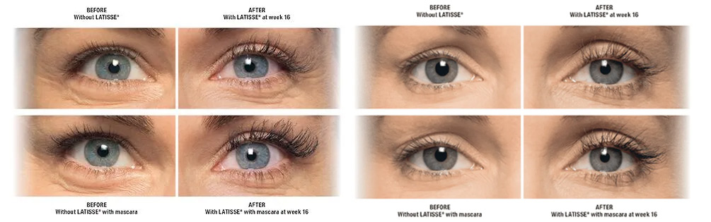 Latisse Before And After Photograph
