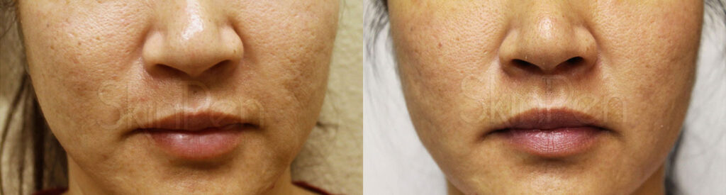 SkinPen before and after photograph