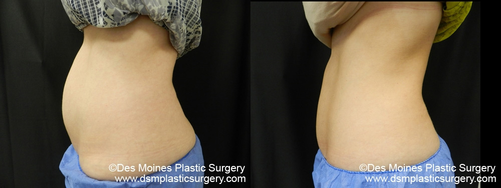 coolsculpting before and after photograph