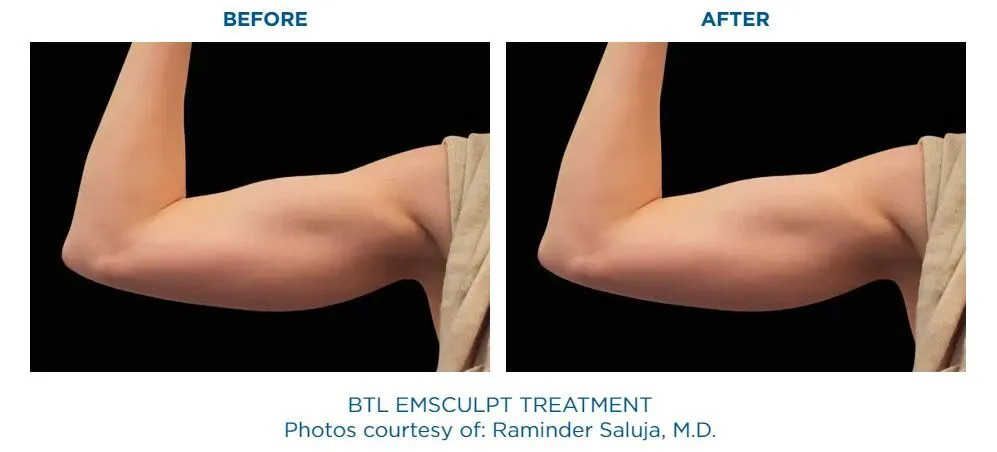emsculpt before and after photo