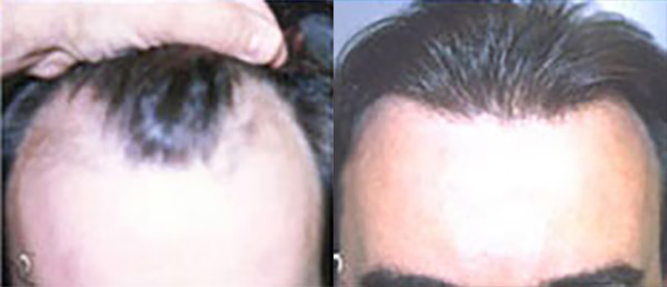 hair loss before after image