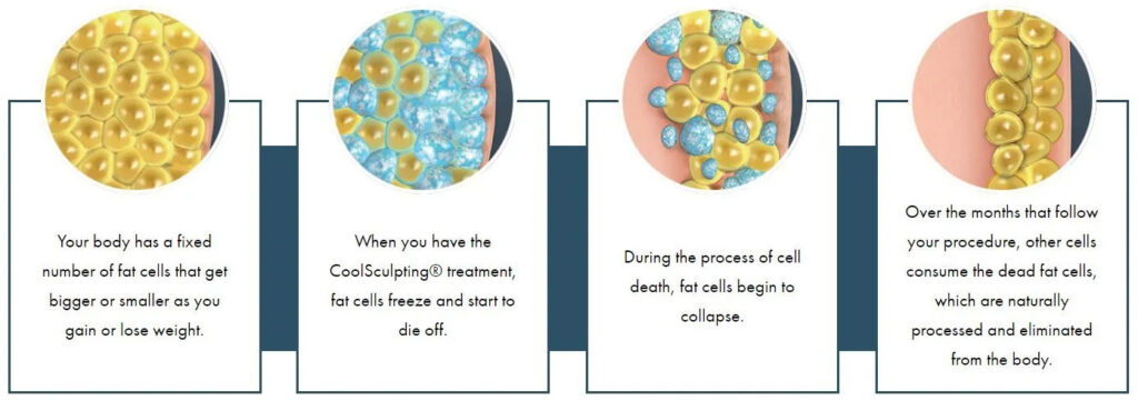 how coolsculpting works