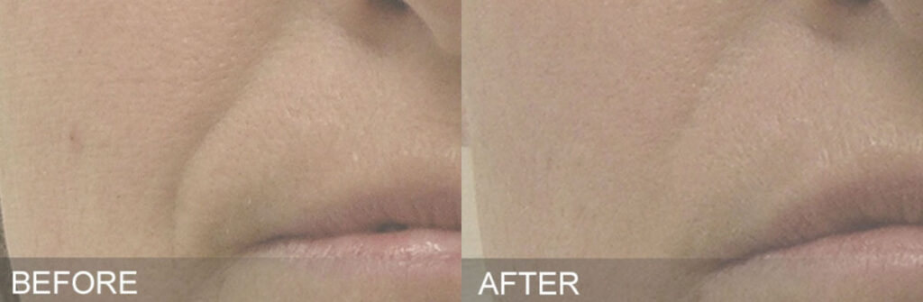 hydrafacial before and after photograph
