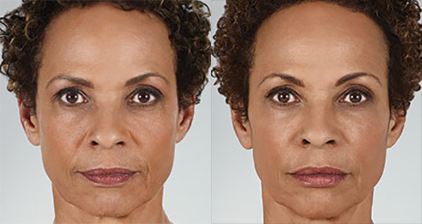 juvederm before and after photograph