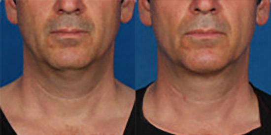 kybella before after man photo