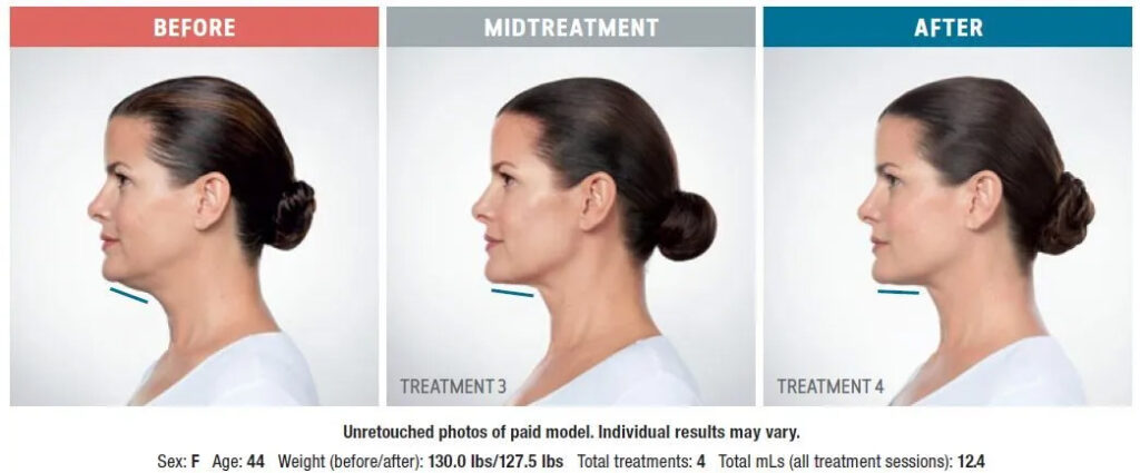 kybella before and after diagram