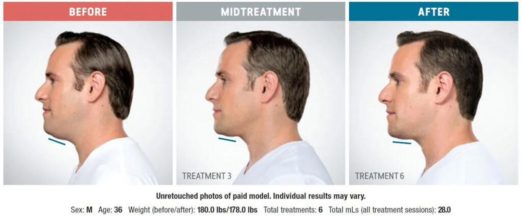 kybella before and after photograph patient