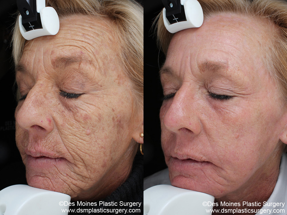 laser resurfacing before and after photograph
