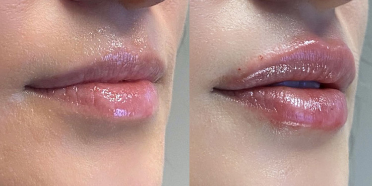 Lip Filler Before And After Photograph