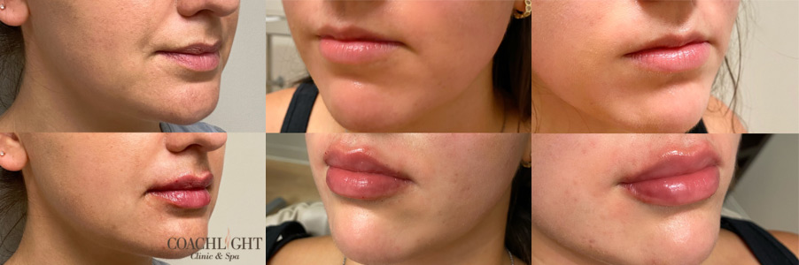 Restylane Kysse 2 Restylane Kysse Before And After Photograph
