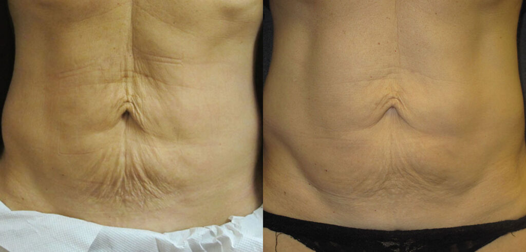 Skintyte 2 Skintyte Before And After Image