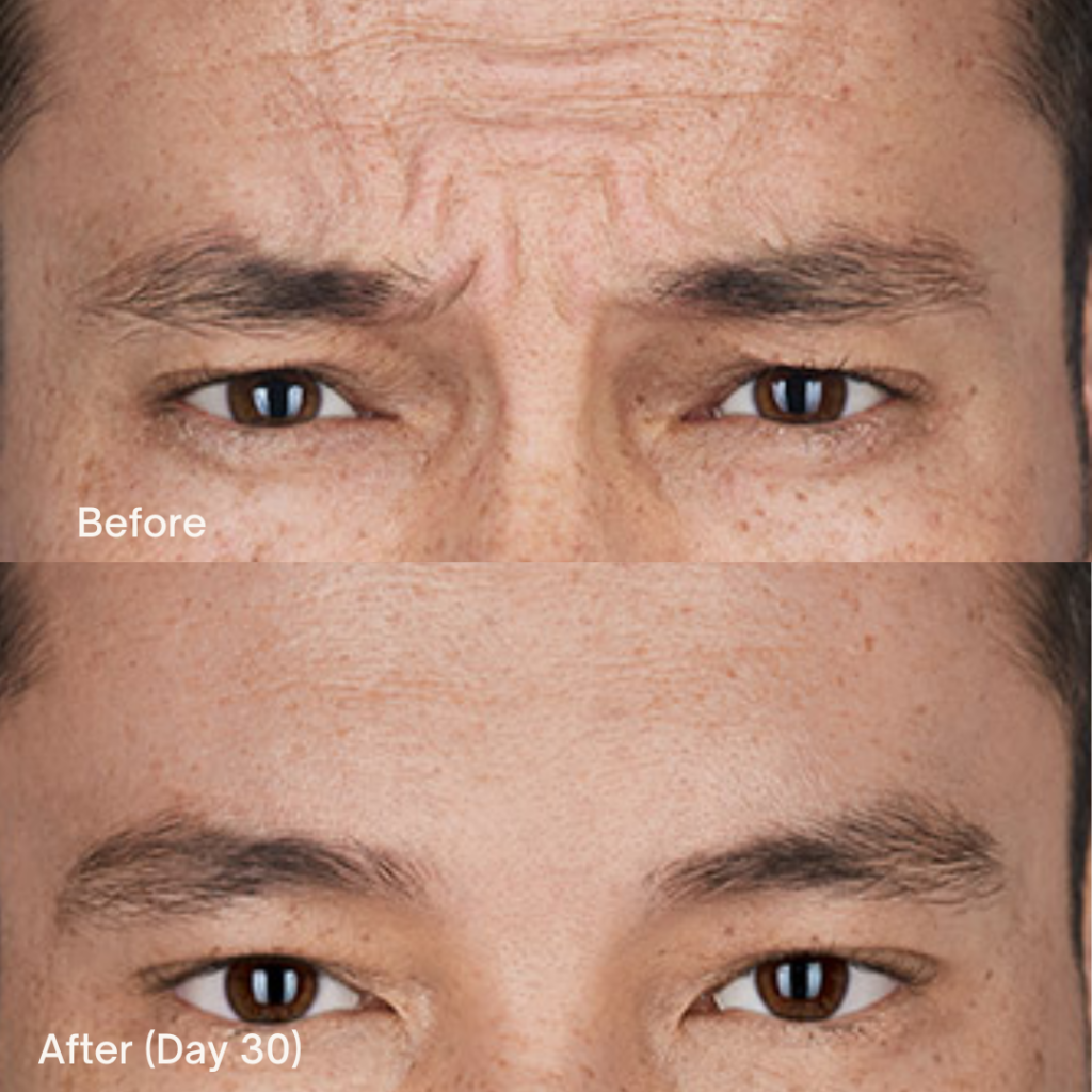 Botox