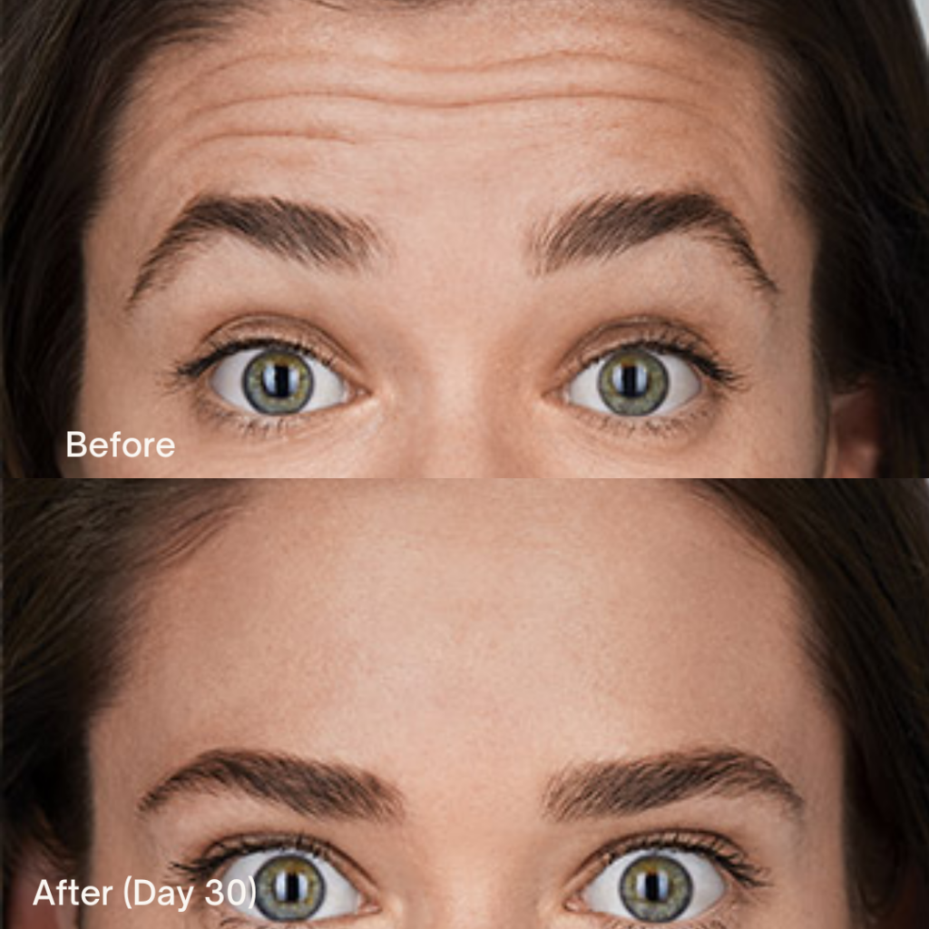 Botox