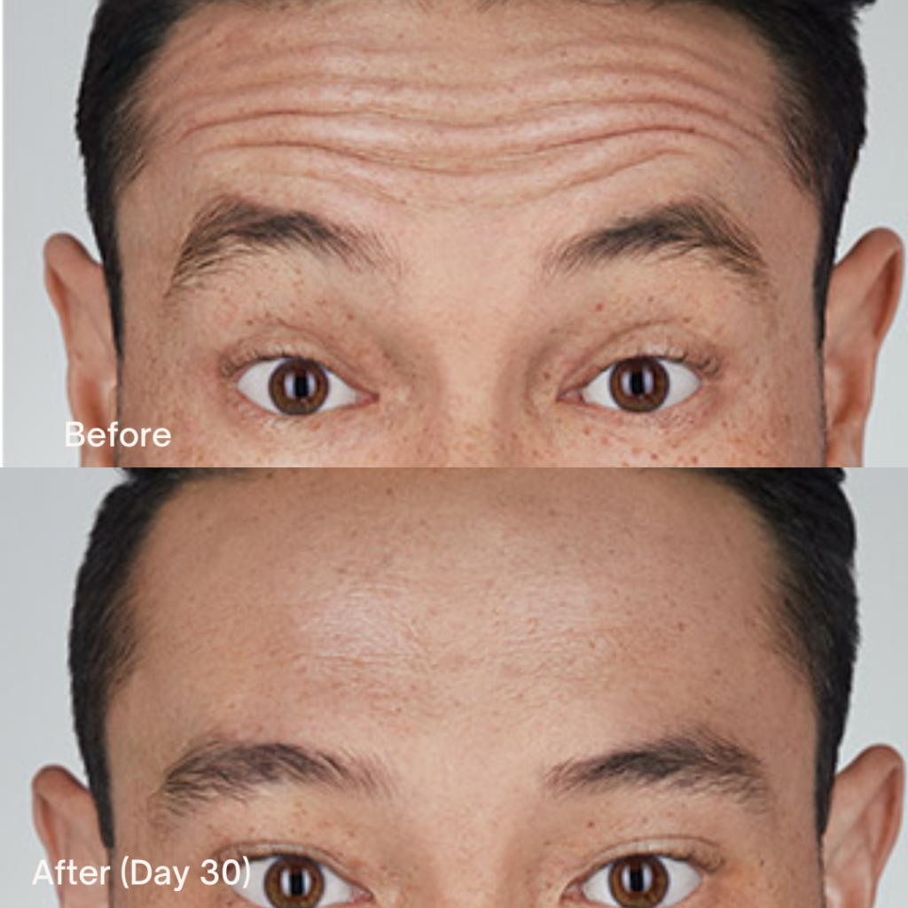Botox
