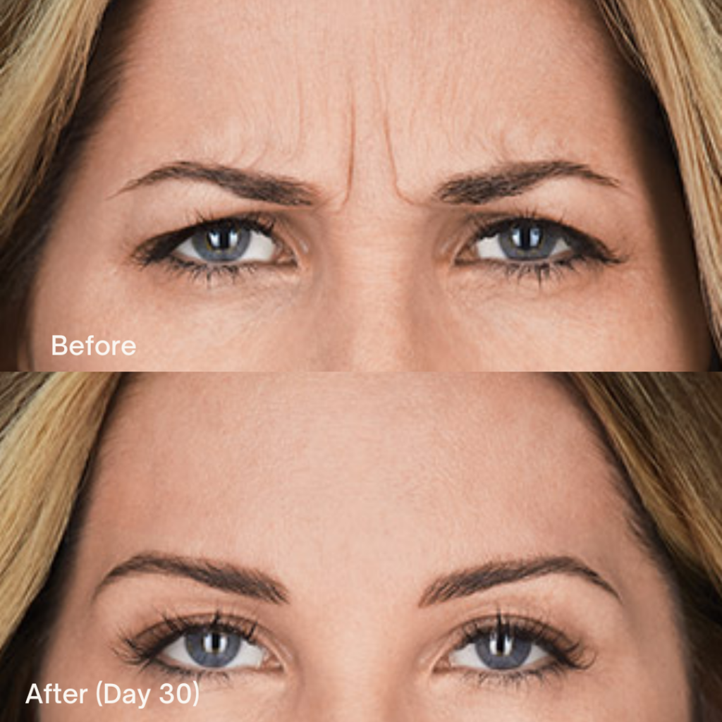 Botox