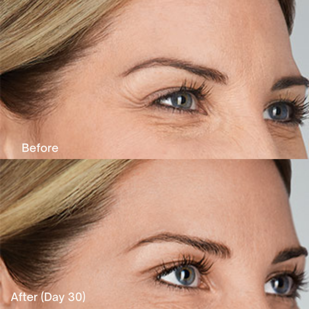 Botox