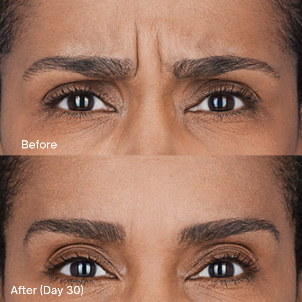 Botox