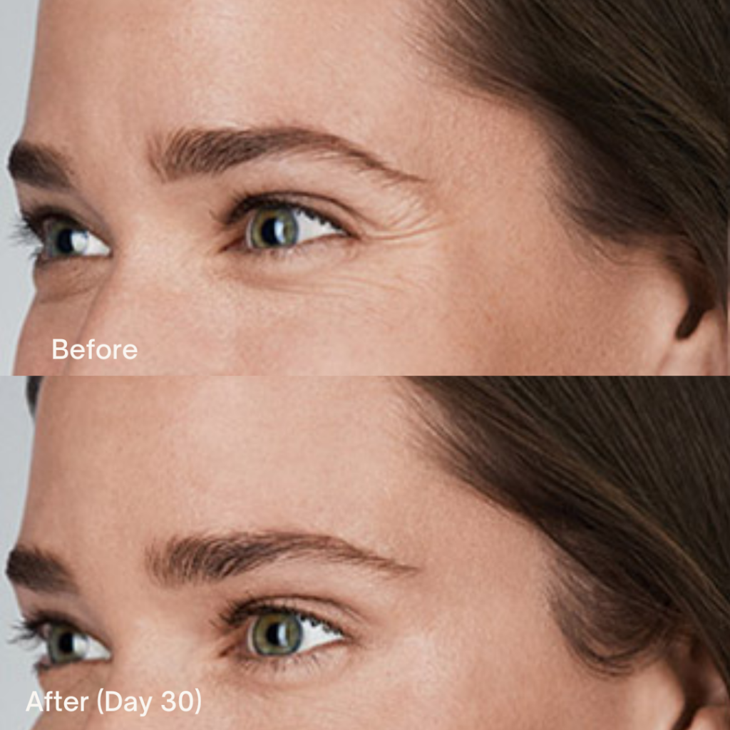 Botox
