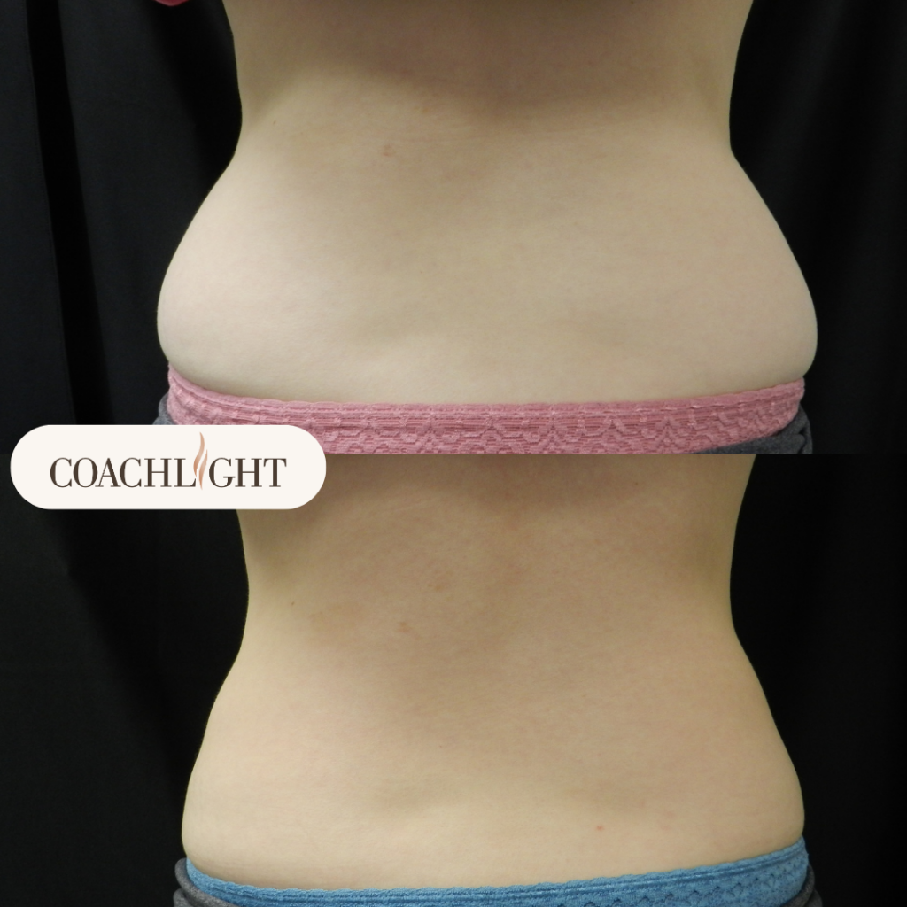 Coolsculpting