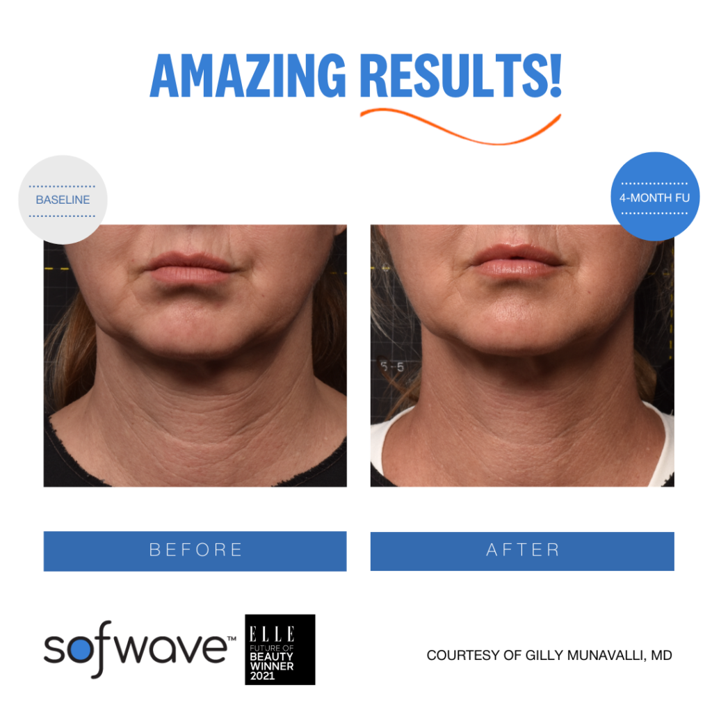Ser Neck