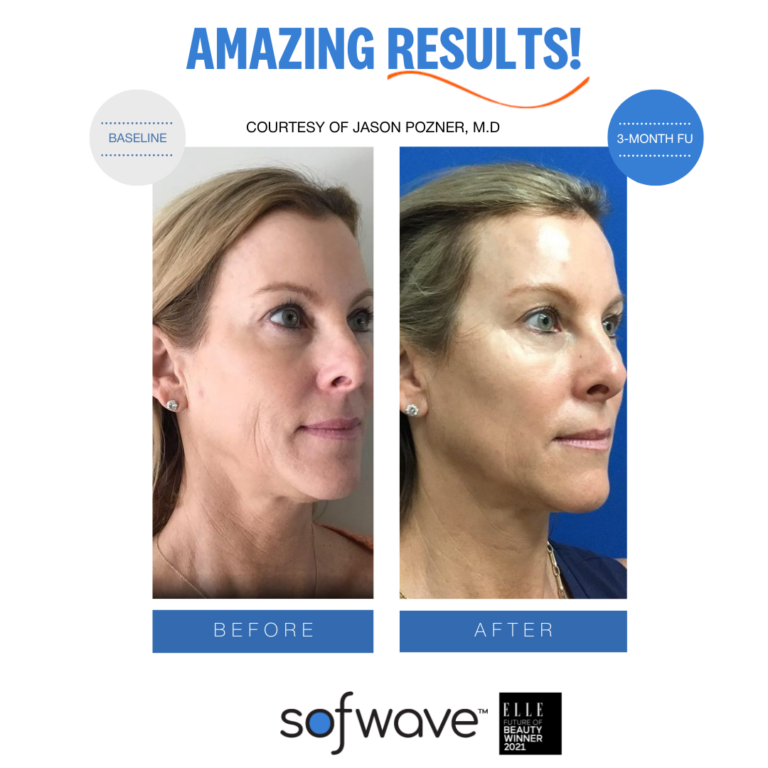 Does Sofwave Address Jowling And Perioral Lines? Here’s What You Need To Know! 3 Set Full Face