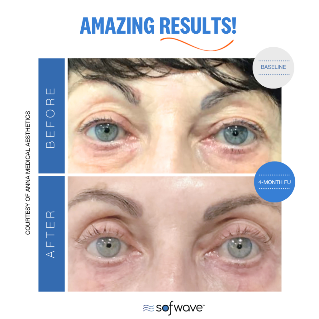 Set Eyebrow