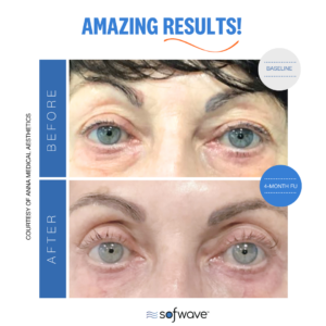 Set Eyebrow
