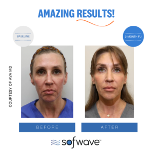 Set Full Face