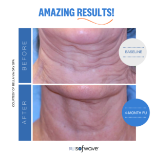 Set Necklift