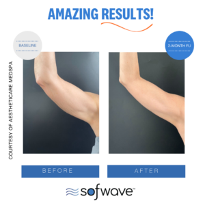 Set Upper Arm