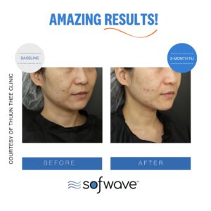 Set Acne Skin Type